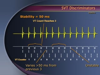 SVT Discriminators
                                      Stability

Stability = 50 ms




   Varies >50 ms from               Unstable
   previous 3
 