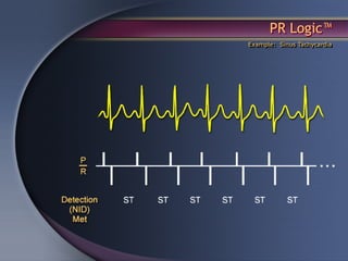 PR Logic™
Example: Sinus Tachycardia
 