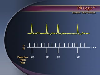 PR Logic™
Example: Atrial Fibrillation
 