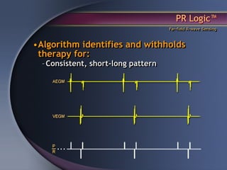 PR Logic™
                                     Far-field R-wave Sensing



•Algorithm identifies and withholds
 therapy for:
  – Consistent, short-long pattern
 