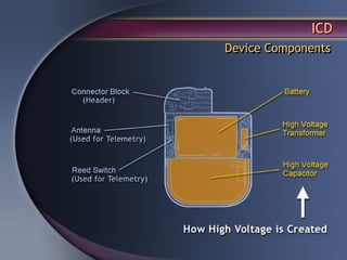 ICD
Device Components
 