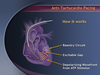 Anti-Tachycardia Pacing
 