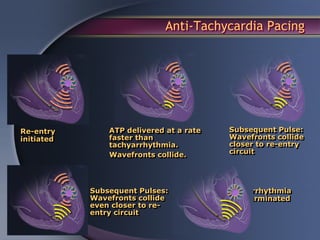 Anti-Tachycardia Pacing




Re-entry        ATP delivered at a rate   Subsequent Pulse:
initiated       faster than               Wavefronts collide
                tachyarrhythmia.          closer to re-entry
                Wavefronts collide.       circuit




            Subsequent Pulses:                Arrhythmia
            Wavefronts collide                terminated
            even closer to re-
            entry circuit
 