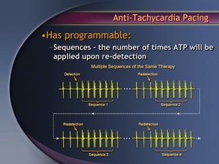 Anti-Tachycardia Pacing

•Has programmable:
 – Sequences – the number of times ATP will be
   applied upon re-detection
 
