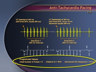 Anti-Tachycardia Pacing
                    Burst
 