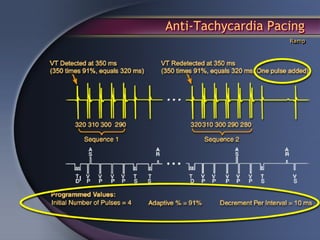 Anti-Tachycardia Pacing
                    Ramp
 