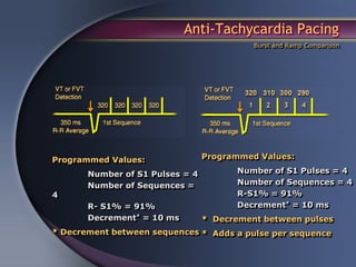 Anti-Tachycardia Pacing
                                           Burst and Ramp Comparison




Programmed Values:               Programmed Values:

       Number of S1 Pulses = 4          Number of S1 Pulses = 4
       Number of Sequences =            Number of Sequences = 4
4                                       R-S1% = 91%
       R- S1% = 91%                     Decrement* = 10 ms
       Decrement* = 10 ms        * Decrement between pulses
* Decrement between sequences * Adds a pulse per sequence
 