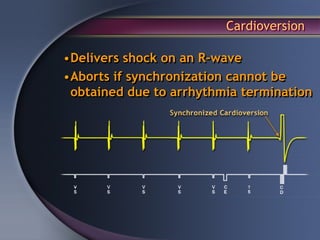 Cardioversion

•Delivers shock on an R-wave
•Aborts if synchronization cannot be
 obtained due to arrhythmia termination
 