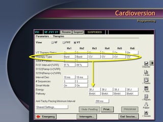 Cardioversion
       Programming
 