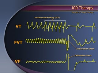 ICD Therapy
      Benefits of Tiered Therapy




VT



FVT



VF
 