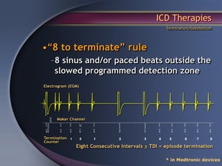 ICD Therapies
                             Termination/Redetection




•“8 to terminate” rule
 –8 sinus and/or paced beats outside the
  slowed programmed detection zone




                            * in Medtronic devices
 