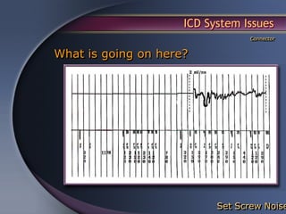 ICD System Issues
                                 Connector


What is going on here?




                           Set Screw Noise
 