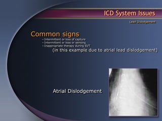 ICD System Issues
                                               Lead Dislodgement



Common signs
  – Intermittent or loss of capture
  – Intermittent or loss or sensing
  – Inappropriate therapy during SVT
         (in this example due to atrial lead dislodgement)




         Atrial Dislodgement
 