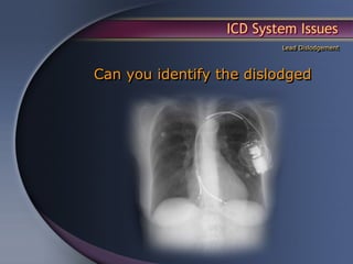 ICD System Issues
                          Lead Dislodgement



Can you identify the dislodged
            lead(s)?
 