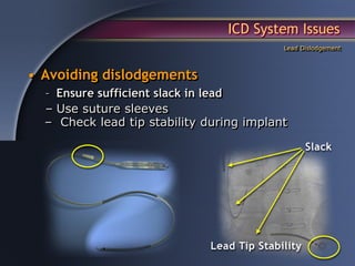 ICD System Issues
                                          Lead Dislodgement



• Avoiding dislodgements
  – Ensure sufficient slack in lead
  – Use suture sleeves
  – Check lead tip stability during implant
 