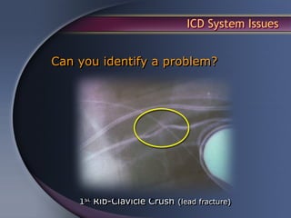 ICD System Issues


Can you identify a problem?




    1st Rib-Clavicle Crush (lead fracture)
 
