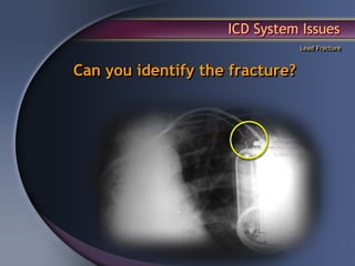 ICD System Issues
                                 Lead Fracture



Can you identify the fracture?
 