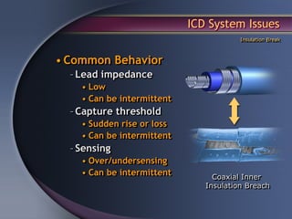 ICD System Issues
                                        Insulation Break



• Common Behavior
  – Lead impedance
    • Low
    • Can be intermittent
  – Capture threshold
    • Sudden rise or loss
    • Can be intermittent
  – Sensing
    • Over/undersensing
    • Can be intermittent        Coaxial Inner
                               Insulation Breach
 