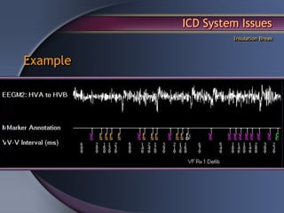 ICD System Issues
                   Insulation Break




Example
 