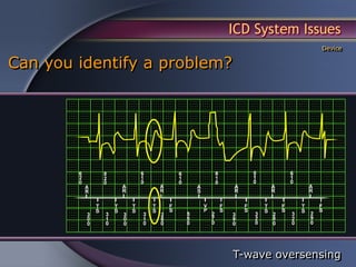 ICD System Issues
                                            Device

Can you identify a problem?




                              T-wave oversensing
 