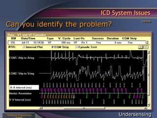 ICD System Issues
Can you identify the problem?
                                        Device




*Medtronic Programming          Undersensing
 
