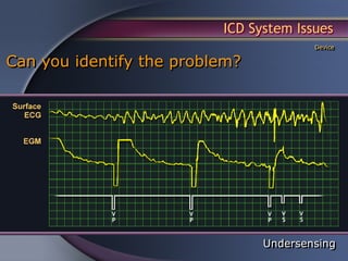ICD System Issues
                                        Device

Can you identify the problem?




                                Undersensing
 