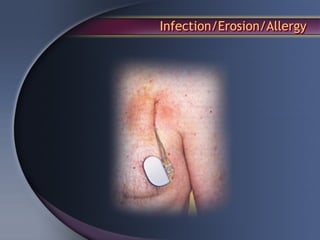 Infection/Erosion/Allergy
 