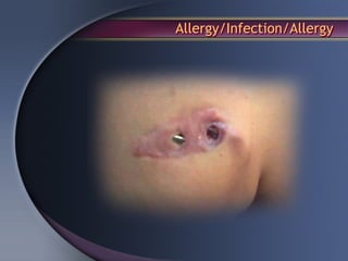 Allergy/Infection/Allergy
 