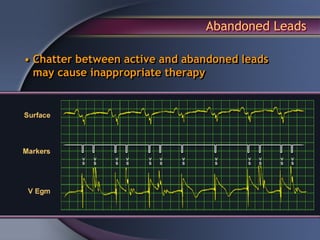 Abandoned Leads

• Chatter between active and abandoned leads
  may cause inappropriate therapy
 