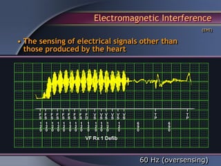 Electromagnetic Interference
                                                    (EMI)


• The sensing of electrical signals other than
  those produced by the heart




                                   60 Hz (oversensing)
 