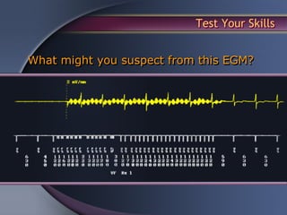 Test Your Skills


What might you suspect from this EGM?
 