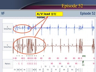 Episode 52
A/V lead 皆有
noise
 