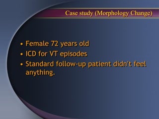 Case study (Morphology Change)



• Female 72 years old
• ICD for VT episodes
• Standard follow-up patient didn’t feel
  anything.
 