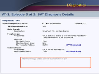 Diagnostics




After morphology update Correct Discreamation is SVT
 