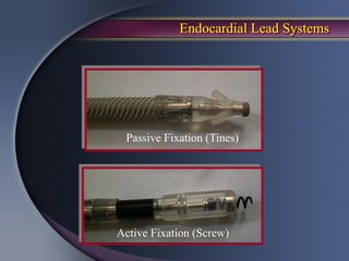 Endocardial Lead Systems




 Passive Fixation (Tines)




Active Fixation (Screw)
 