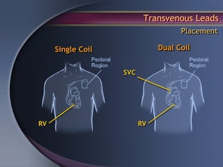 Transvenous Leads
                       Placement

Single Coil      Dual Coil
 