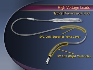High Voltage Leads
Typical Transvenous Lead
 