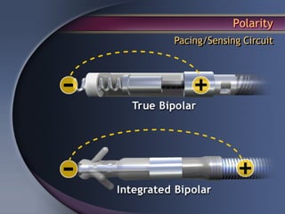 Polarity
Pacing/Sensing Circuit
 
