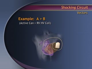 Shocking Circuit
                                     Vectors
Example: A > B
(Active Can > RV HV Coil)
 