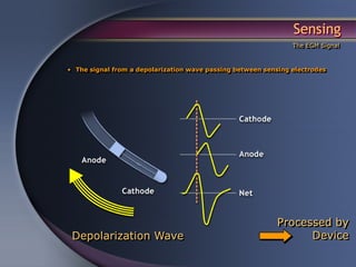 Sensing
                                                                The EGM Signal



• The signal from a depolarization wave passing between sensing electrodes




                                                            Processed by
 Depolarization Wave                                              Device
 