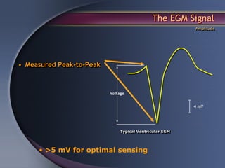 The EGM Signal
                                                    Amplitude




• Measured Peak-to-Peak




                          Typical Ventricular EGM




     • >5 mV for optimal sensing
 