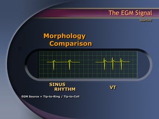 The EGM Signal
                                                  Nearfield




              Morphology
               Comparison




                  SINUS
                    RHYTHM               VT
EGM Source = Tip-to-Ring / Tip-to-Coil
 