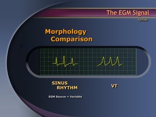 The EGM Signal
                                  Farfield



Morphology
 Comparison




  SINUS
    RHYTHM               VT

EGM Source = Variable
 