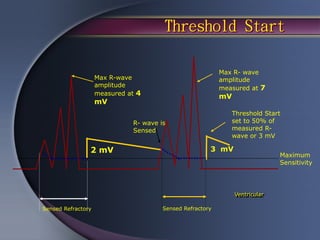 Threshold Start

                                                           Max R- wave
                    Max R-wave                             amplitude
                    amplitude                              measured at 7
                    measured at 4
                                                           mV
                    mV
                                                              Threshold Start
                              R- wave is                      set to 50% of
                              Sensed                          measured R-
                                                              wave or 3 mV

                2 mV                                   3 mV
                                                                              Maximum
                                                                              Sensitivity




                                                                Ventricular

Sensed Refractory                      Sensed Refractory
 
