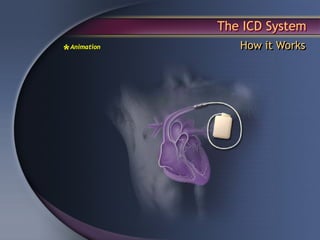 The ICD System
                   How it Works
*   Animation
 