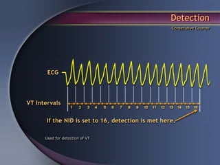 Detection
                           Consecutive Counter




Used for detection of VT
 