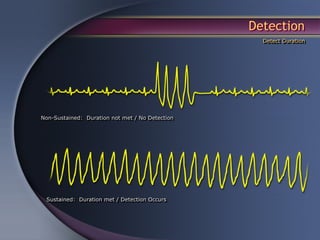 Detection
                                                   Detect Duration




Non-Sustained: Duration not met / No Detection




 Sustained: Duration met / Detection Occurs
 