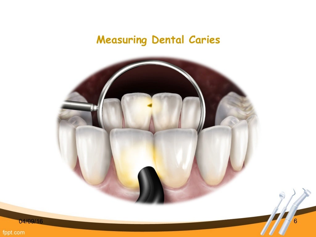International Caries Detection and Assessment System (ICDAS)