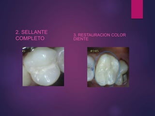2. SELLANTE
COMPLETO
3. RESTAURACION COLOR
DIENTE
 