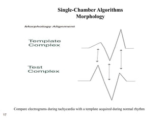 17
Compare electrograms during tachycardia with a template acquired during normal rhythm
Single-Chamber Algorithms
Morphology
 